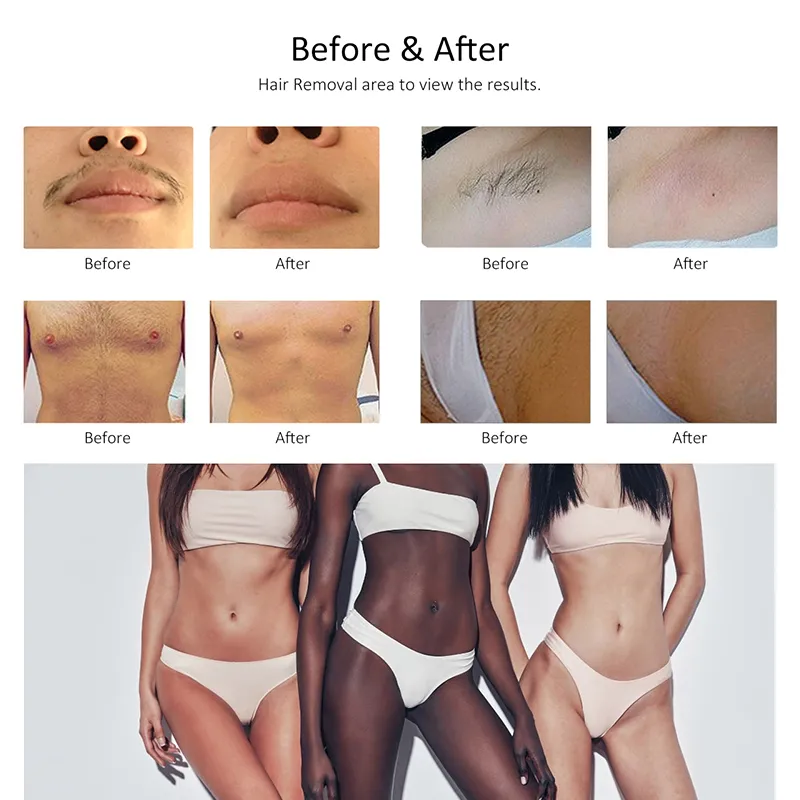 Advanced Titanium Diode Laser Hair Removal System for Beauty Salons