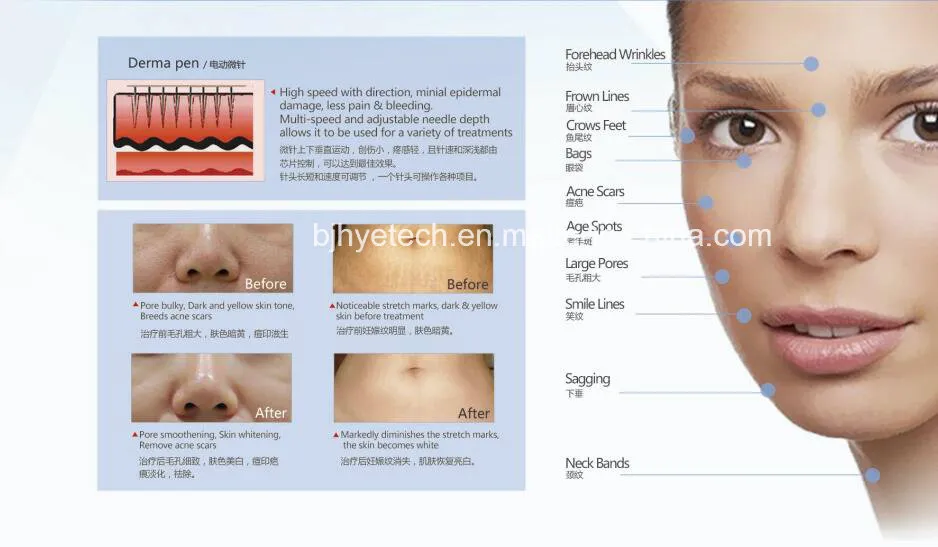 Treatment effect of the derma pen