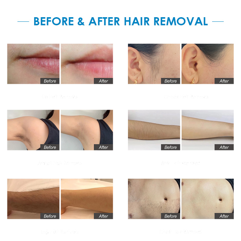 Eos ICE Best Professional Diode Laser Hair Removal 755 808 1064 1200W Salon Hair Removal Diode Laser Hair Removal Machine Price