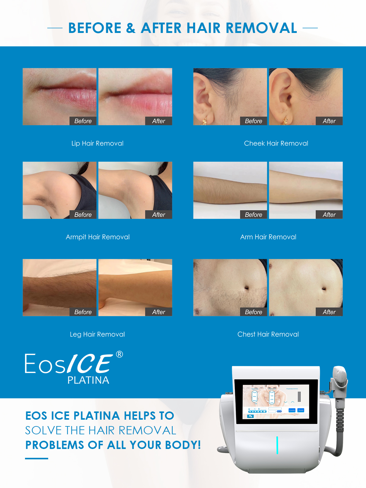 Portable 3 Wavelengths 755nm 808nm 1064nm Whole Body Use Painless High Power Laser Hair Removal 808 Diode Laser Machine