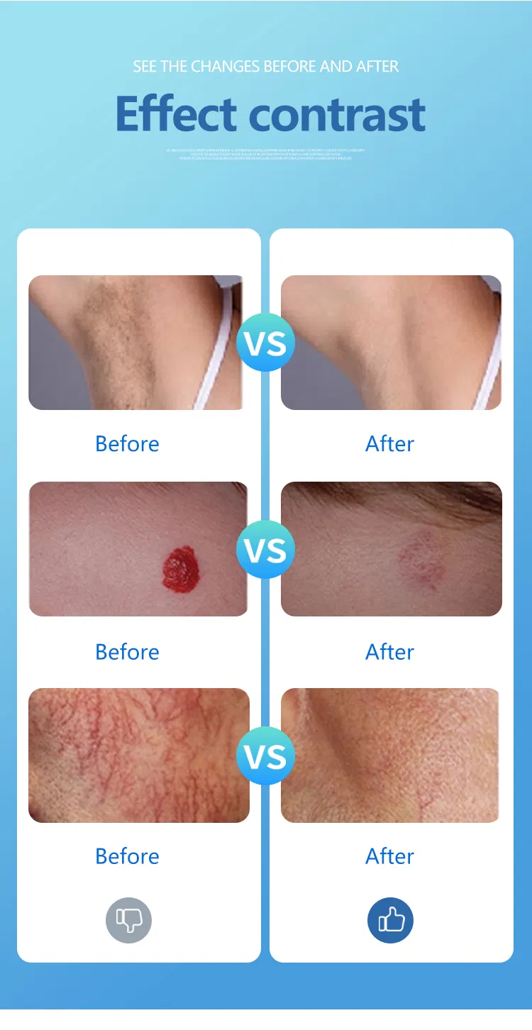755nm Alexandrite Laser Hair Removal - Advanced Pulsed Alexandrite Technology