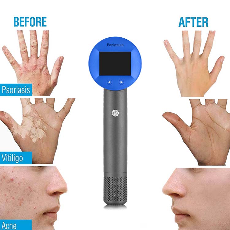 Peninsula Scalp Psoriasis Treatment Device OEM 308nm Led Red Light Therapy Device Excimer Laser Skin Care Product Machine
