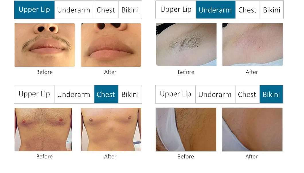 Before after results on skin types