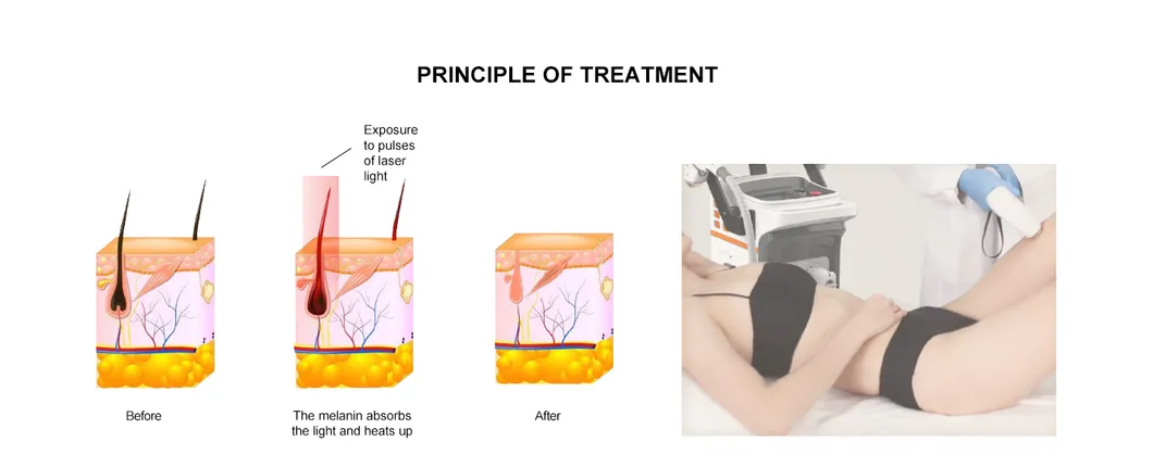 Diode Laser Specifications Features