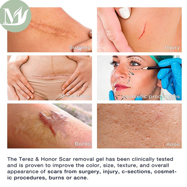 OEM Advance Silicon Scar Gel for Sensitive Skin Types