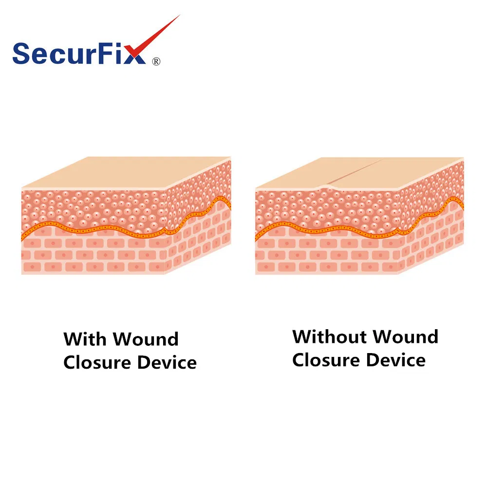Wound Closure Bandage 5