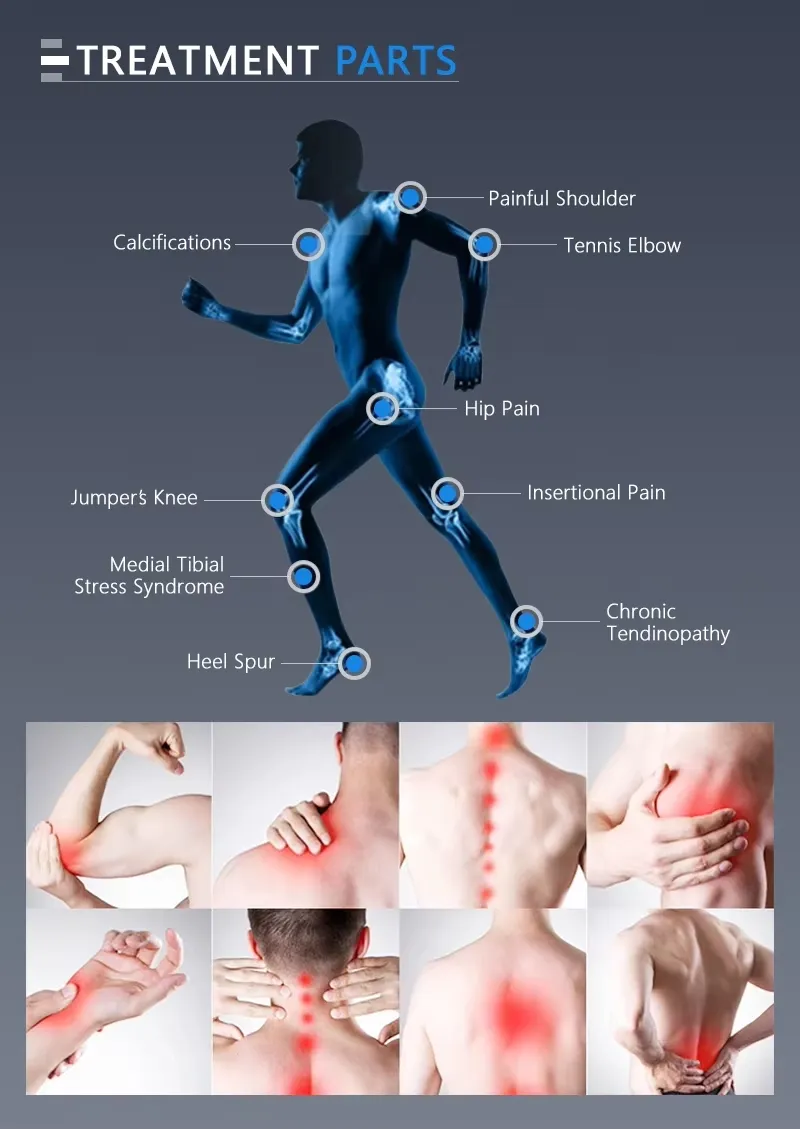 Shockwave Treatment Areas