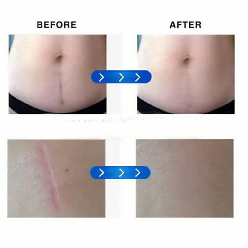 Silicone Gel Sheet Usage 4