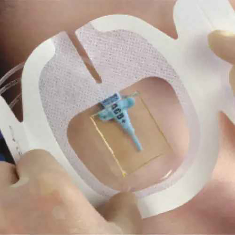 Disposable Medical IV Dressing Pad Stretchable Transparent Film with Chg Core for Wound and Catheter Protection