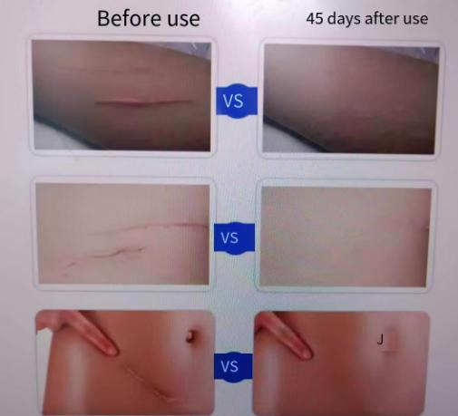 Silicone Scar Gel for Scar Reduction