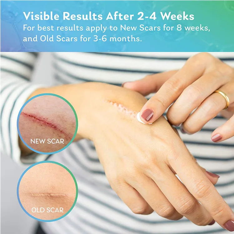 Silicone Scar Treatment Gel 3