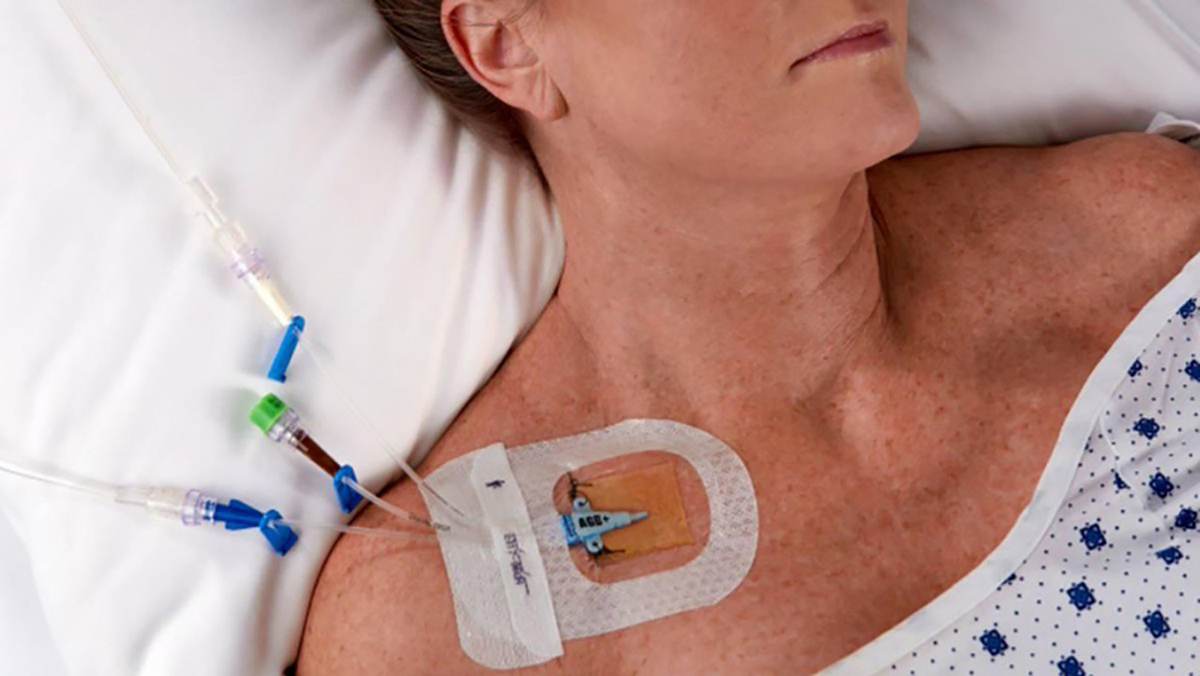 Disposable Medical IV Dressing Pad Stretchable Transparent Film with Chg Core for Wound and Catheter Protection