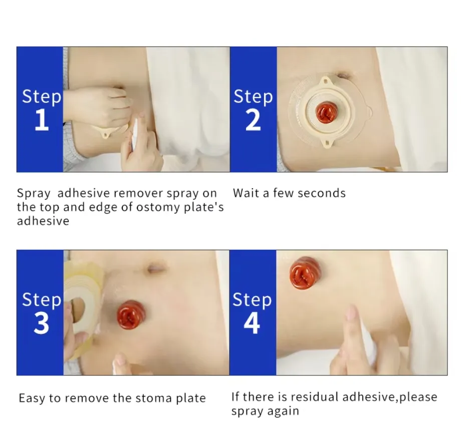Ostomy Care Spray Application