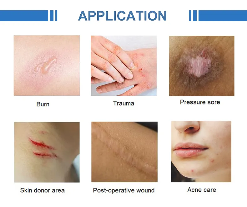Hydrocolloid Dressing Detail 5