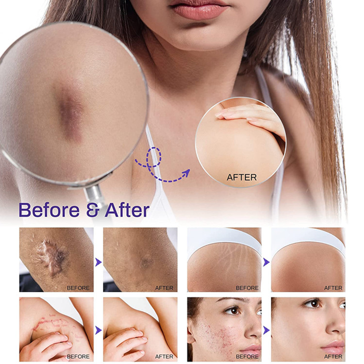 OEM ODM Advanced Scar Treatment Removal Cream Scar Repair Gel