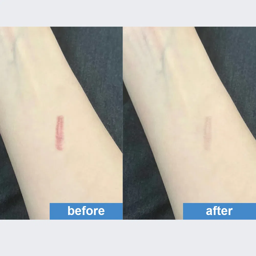 Silicone Scar Sheets Detail 6