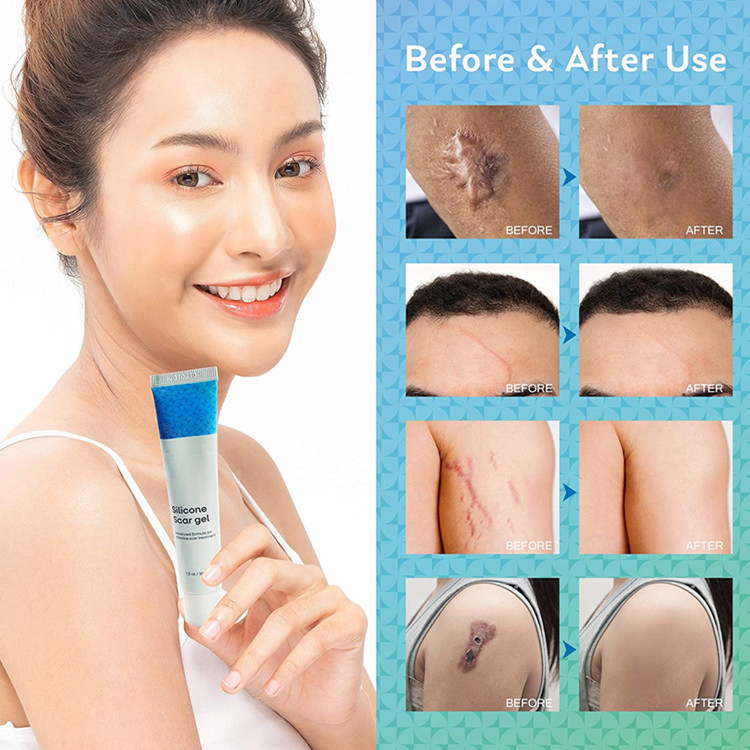 OEM Advanced Silicone Scar Treatment Face and Body Skin Repair Acne Gel