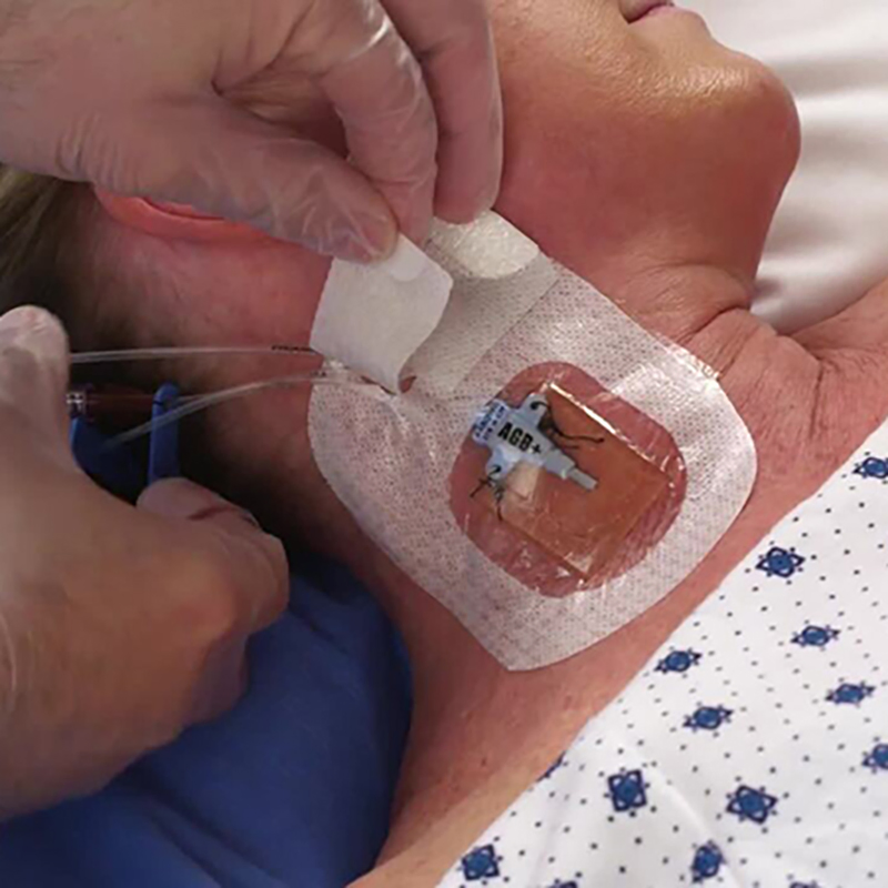 Disposable Medical IV Dressing Pad Stretchable Transparent Film with Chg Core for Wound and Catheter Protection