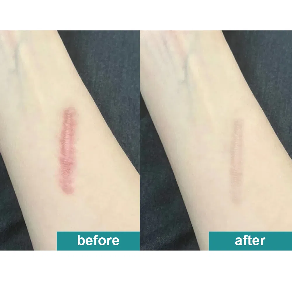 Huawei OEM Silicone Scar Removal Sheets Gel Scar Strips Scar Cover up Tape Stretch