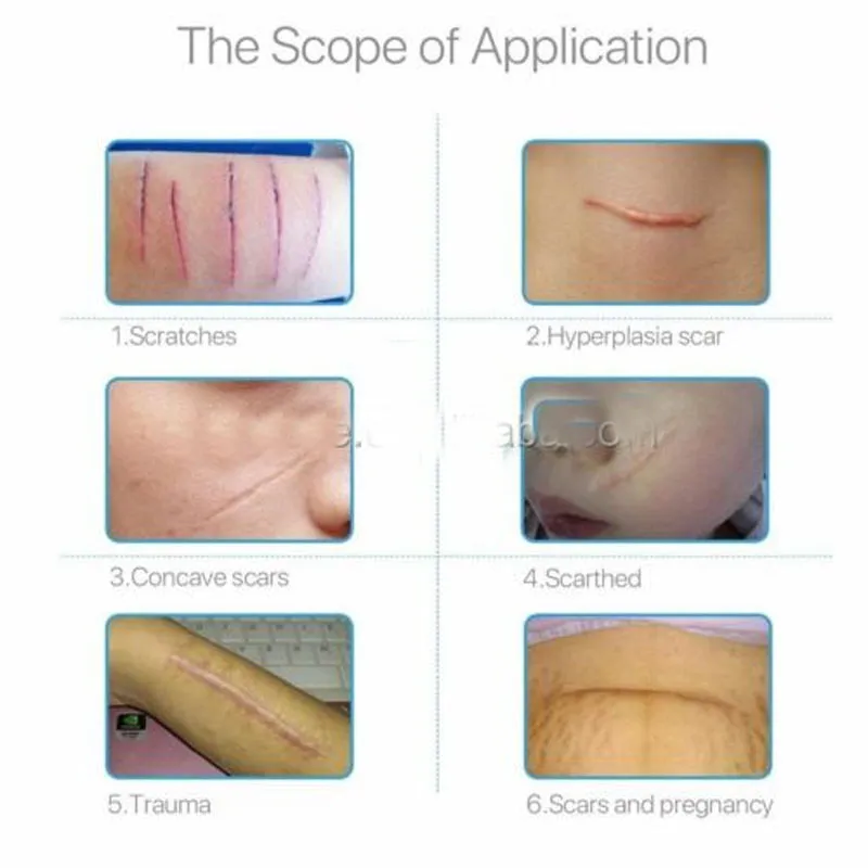 Silicone Scar Gel Sheet Usage 5