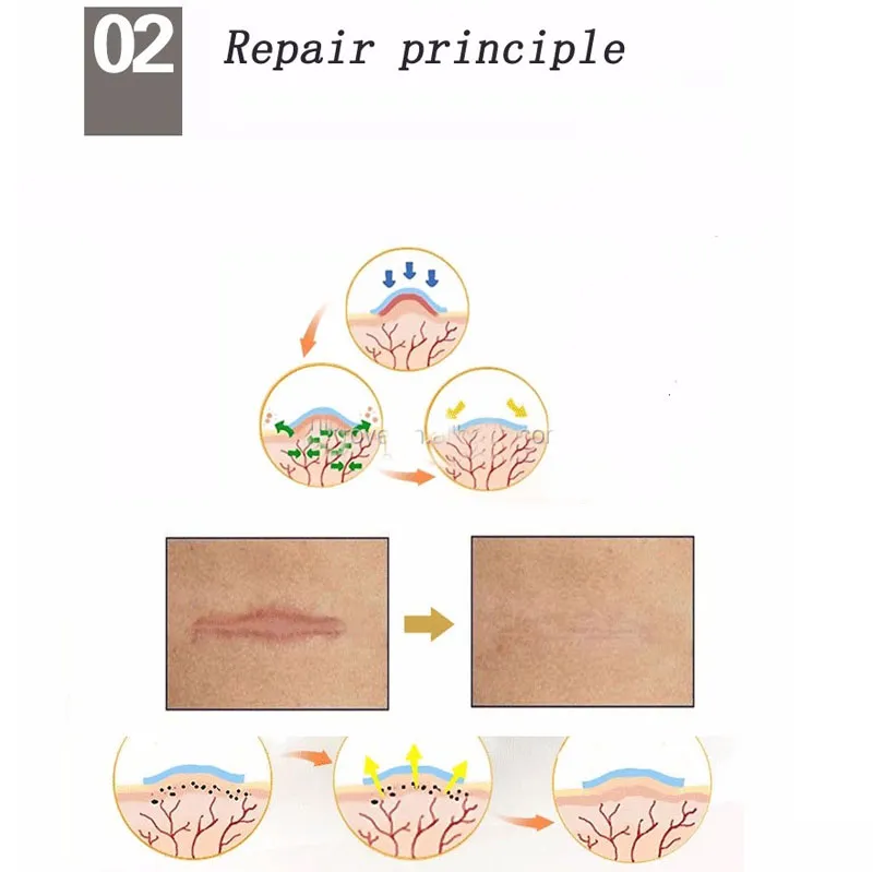 Silicone Scar Gel Sheet Usage 2
