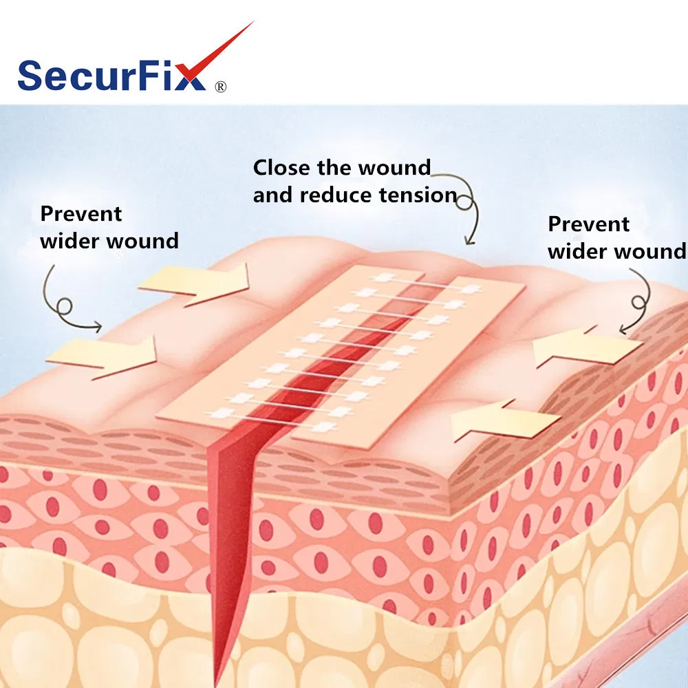 Transparent PU Film Wound Closure Bandage 6cm*6cm Scar Reduction Tension Relieve Without Suture Surgical Dressing OEM Manufacturer