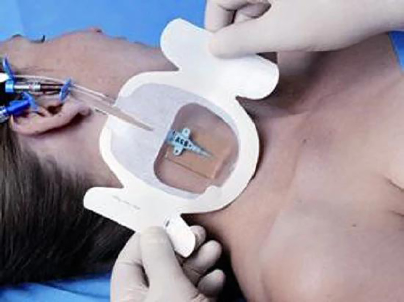 Transparent 2% Chlorhexidine Gluconate Chg IV Catheter/Cannula Fixation Dressing