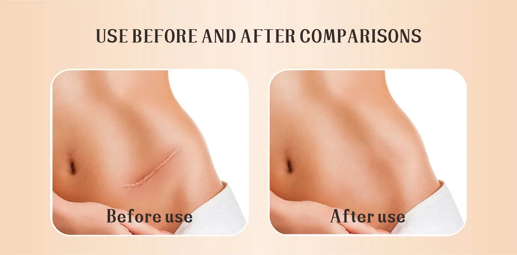 Silicone Scar Repair Tape Detail 4