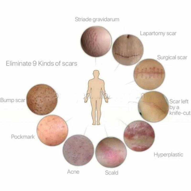 Silicone Scar Gel Sheet Usage 6