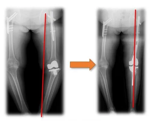 Hip Dysplasia Replacement 2