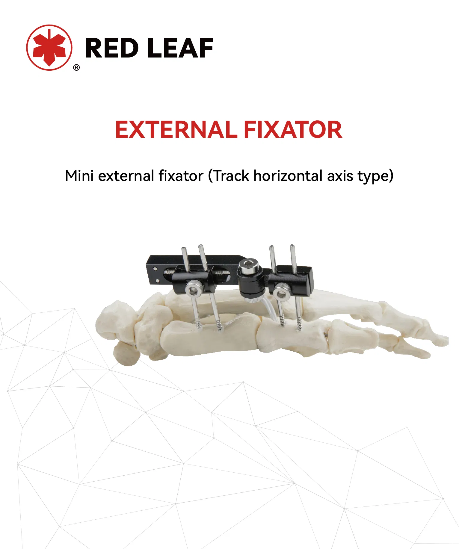 External Fixator Overview