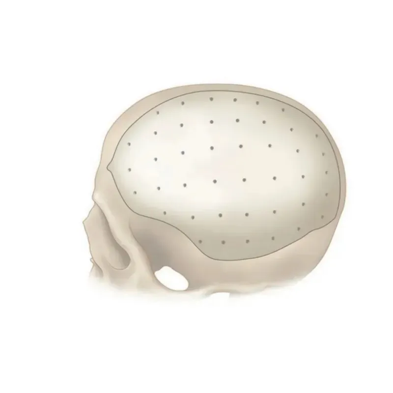 Surgical Peek Patient Specific Implant Detail 1