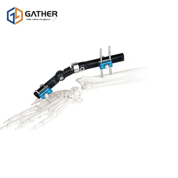 External Fixator Detail 2