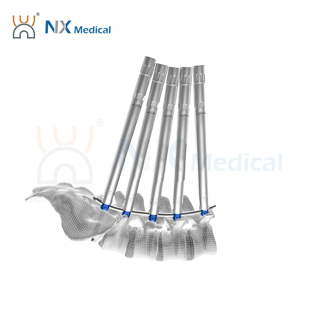 Nx Medical Cannulated Bone Cement Pedicle Screw Bone Internal OEM ODM Support