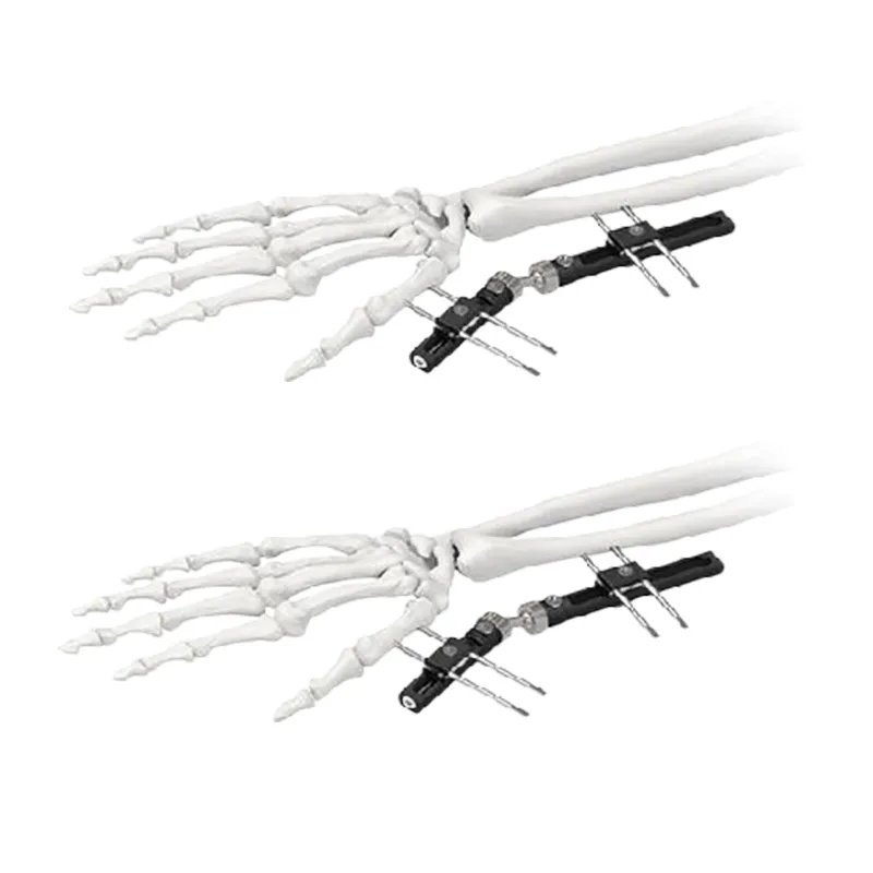 Ilizarov External Fixator with Foot Ring