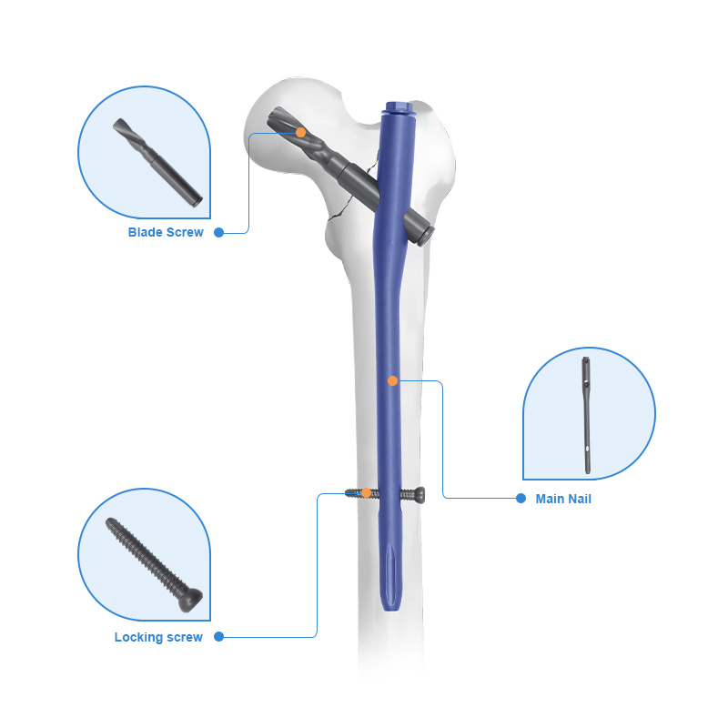 Medical Supply Orthopedic Implant Titanium Femur Pfna Intramedullary Nail Instrument Set