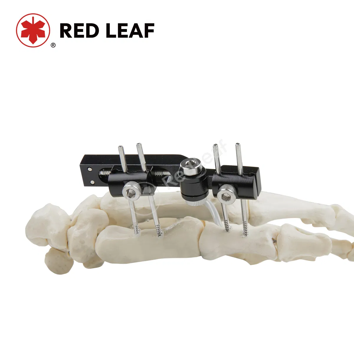 Premium Palm External Fixator Orthopedic Finger Fracture Fixation Device for Recovery