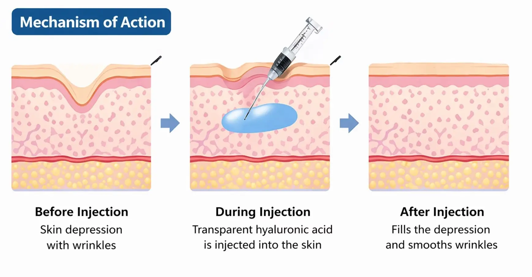 Hyaluronic acid dermal filler application steps