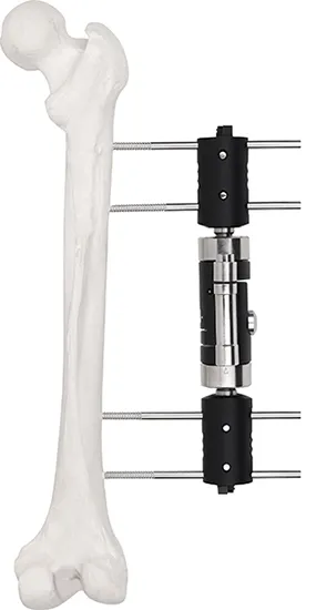 External Fixator--Dynamic Axial Fixator