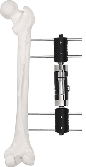 External Fixator--Dynamic Axial Fixator