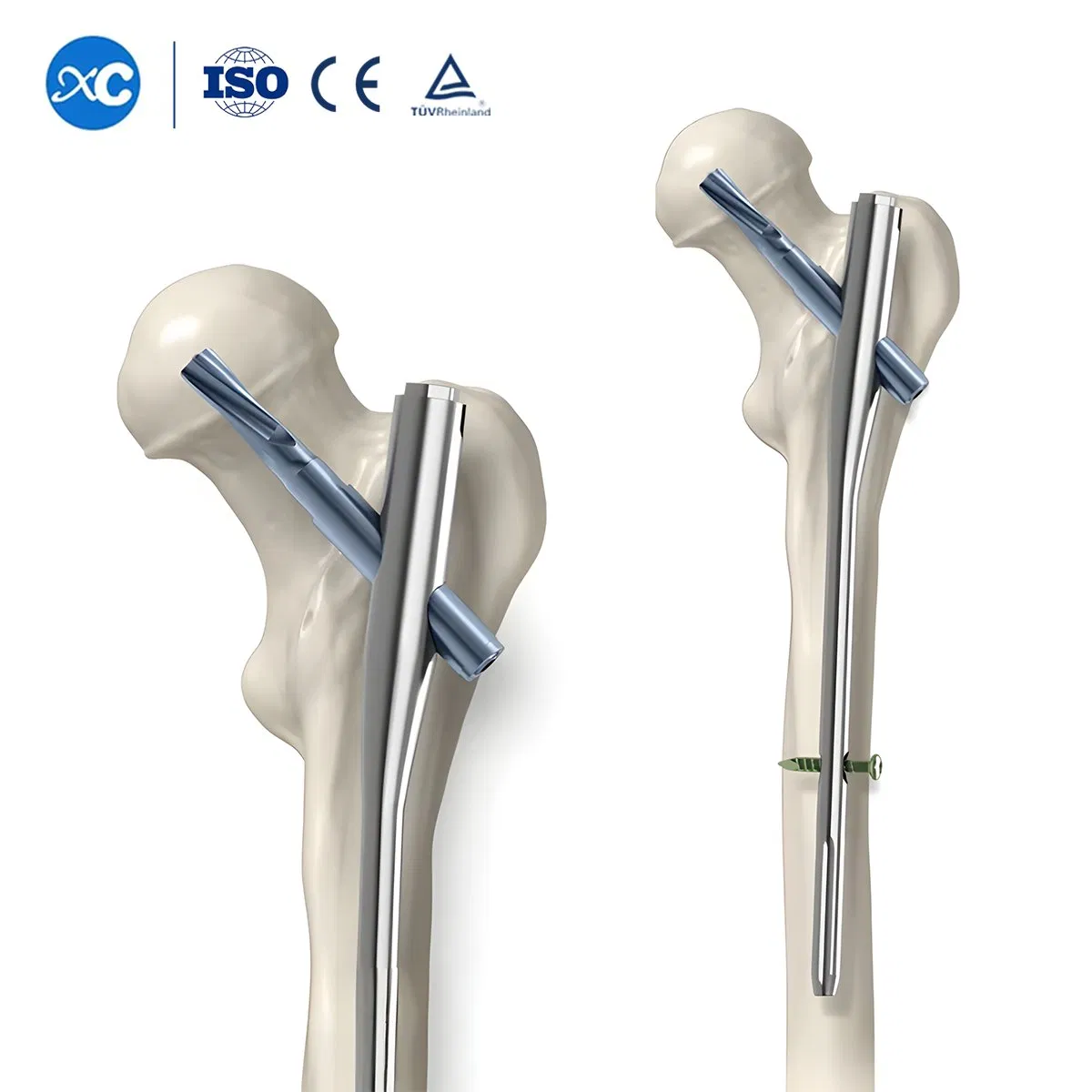 Trauma Surgery Implants Gama Interlocking Pfna Intramedullary Nail