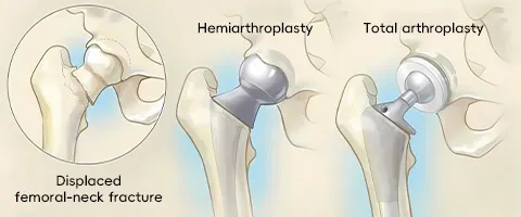 Hip Replacement Options