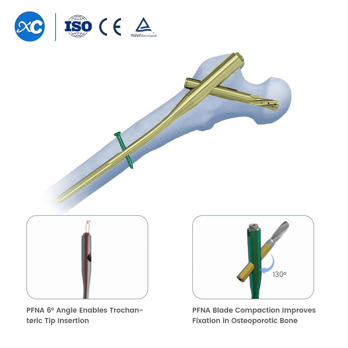 Trauma Surgery Implants Gama Interlocking Pfna Intramedullary Nail