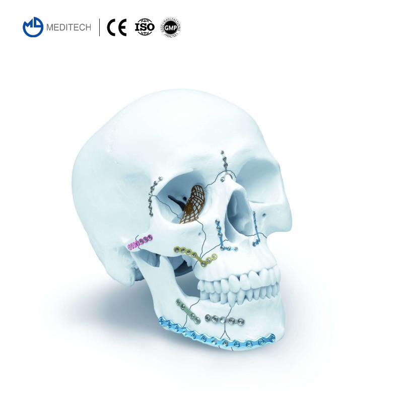 Titanium Cmf Locking Plates and Screws-Maxillofacial Orthopedic Implant System