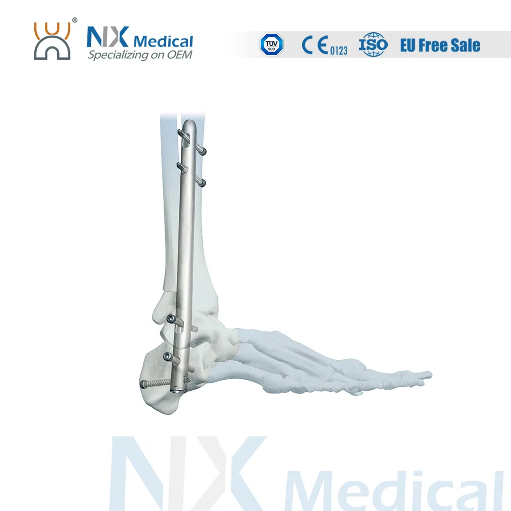 Nx Medical Premium Quality Ankle Fusion Nail Bone Fixation Interlocking Intramedullary Nail
