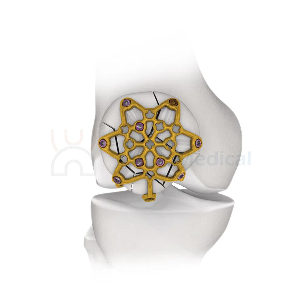 Nx Medical Trauma Variable Angle Patella Locking Plate From China