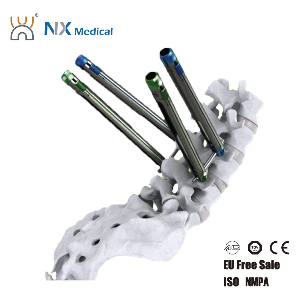 Nx Medical Cannulated Bone Cement 5.5mm System Pedicle Screw Spine Internal Fixation