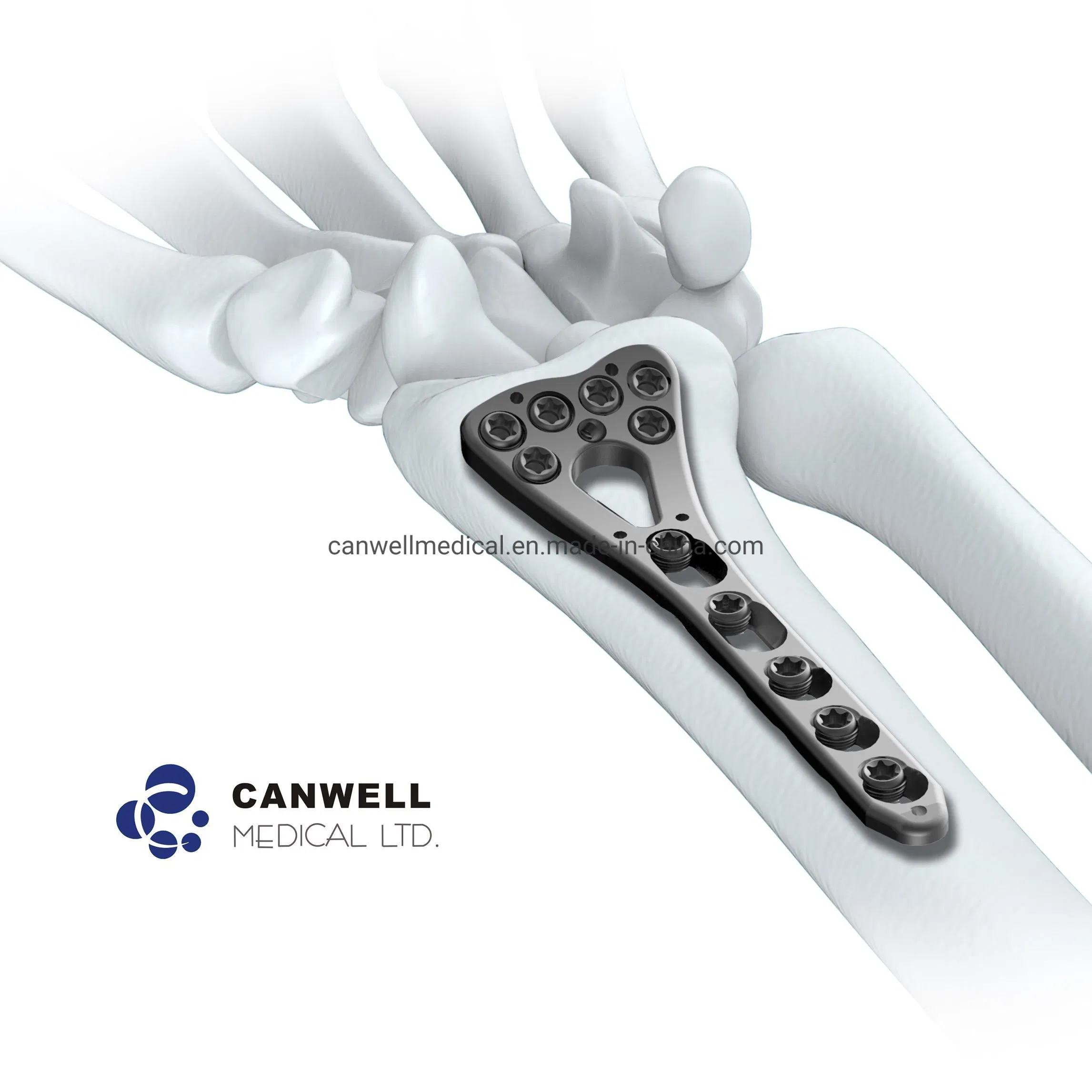 Canwell Distal Radius Ulna Fracture Surgical Implant and Medical Orthopaedic Trauma Small Fragment Fixation Surgery Orthopedic Titanium Bone Locking Screw Plate