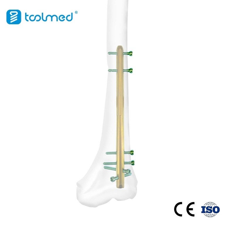Orthopedic Trauma Interlocking Intramedullary Nail for Femur 9.5*340