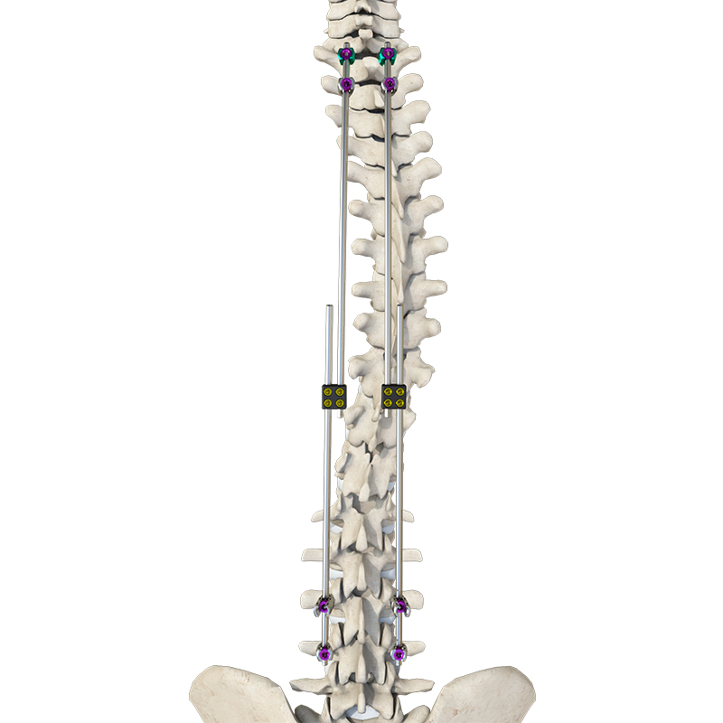 High-Precision Lamina Hook for Spine and Pelvis Surgery